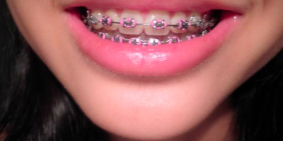 Best Pediatric Orthodontic Care In Whitefield