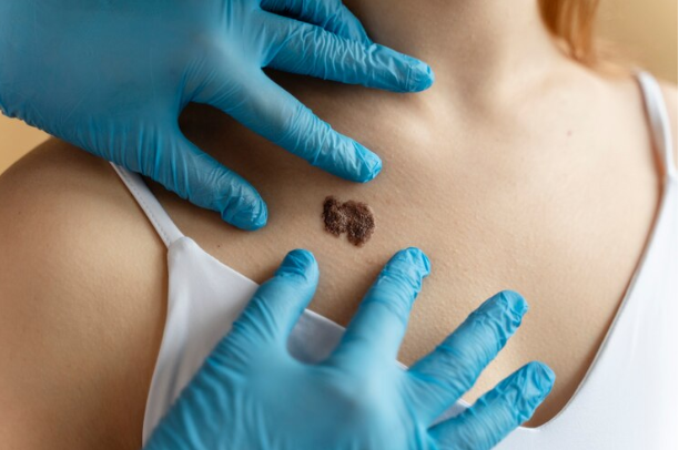 Cyst removal - Shanti Madan Memorial Hospital