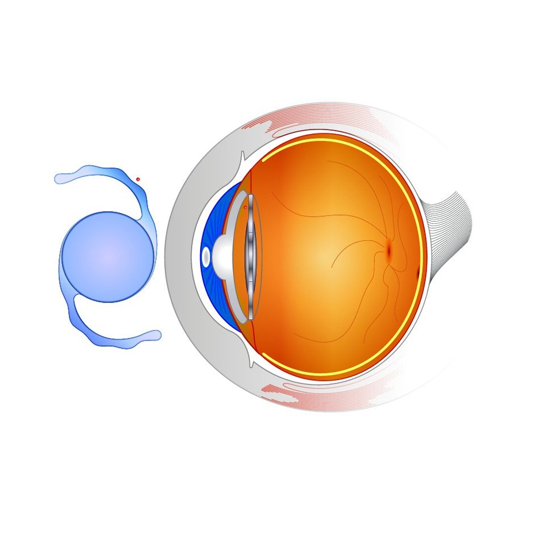 Best Cataract Hospital in Panipat - Navjeevan Hospital