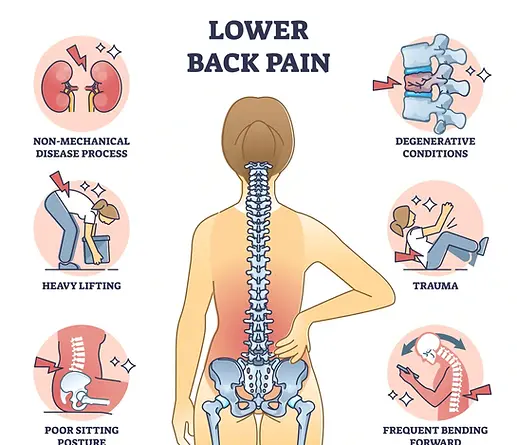 Low Back Pain Newport Beach, Chiropractic Treatments for Back Pain
