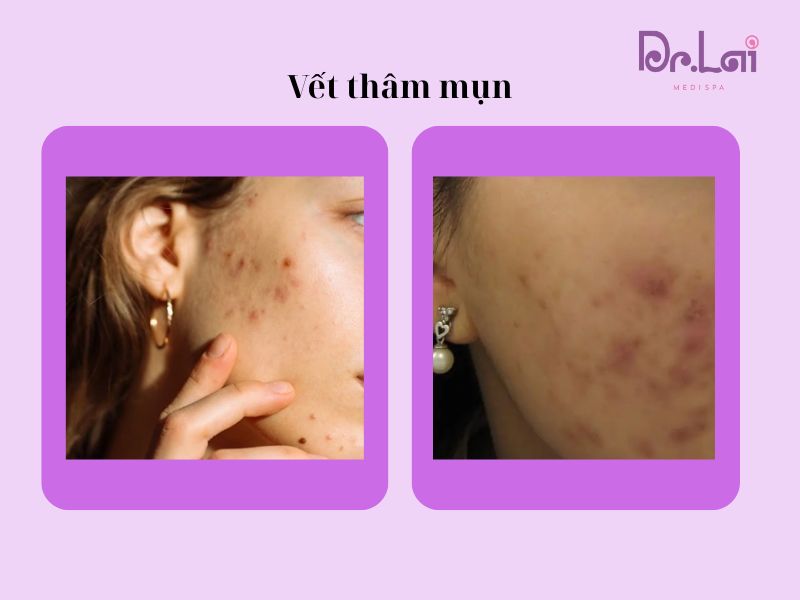 Quy trình trị thâm mụn chuẩn y khoa hiệu quả, an toàn