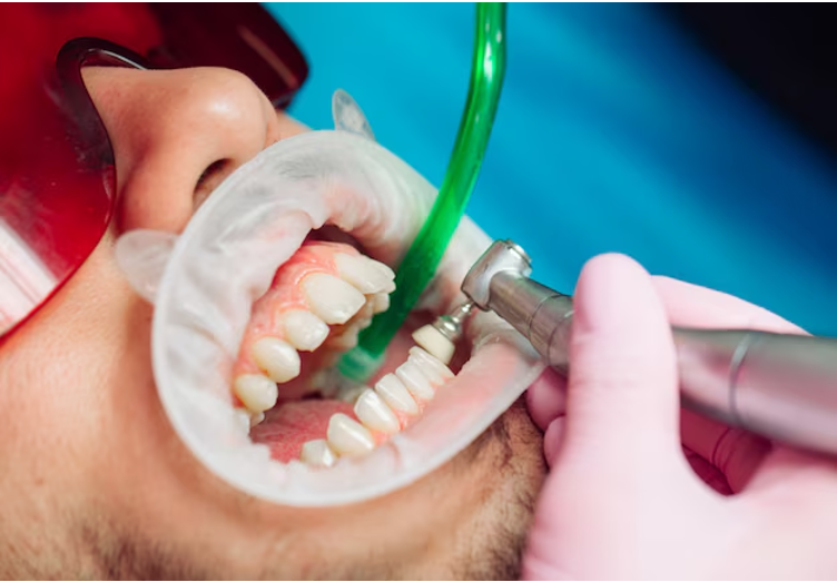When Was Your Last Professional Teeth Cleaning in Al Ain? Here's Why You Shouldn't Wait