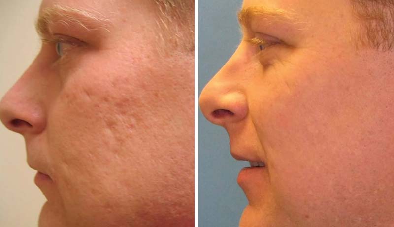 Acne Scar Treatment Cape Town | Atlantic Dermatology & Laser